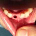 Implant avant prise d'empreinte Implant avant prise d'empreinte