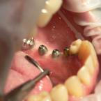 3 implants avec leur vis de cicatrisation 3 implants avec leur vis de cicatrisation