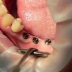 3 implants avec hexagone externe sans les vis de cicatrisation 3 implants avec hexagone externe sans les vis de cicatrisation