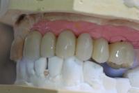 assemblage prothèse dentaire