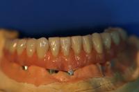 remplacement dentition