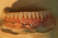 conception dentier