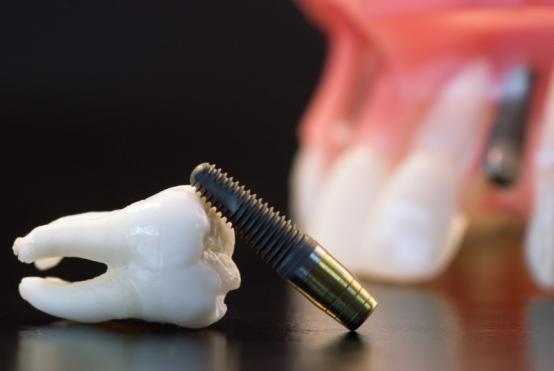 matériaux implant dentaire