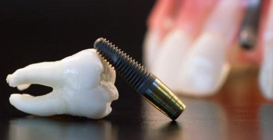 conception prothèse dentaire